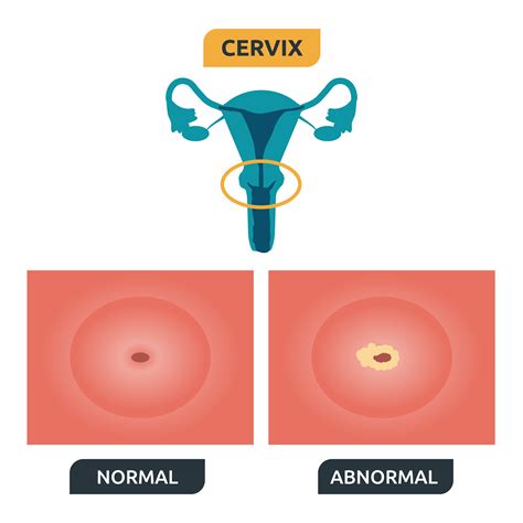 Cervix Con Eritroplasia Periorificial