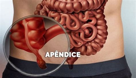 Qual Função Do Apendice - Onde Fica O Apêndice – Apêndice: onde fica, o que é, função, anatomia ...
