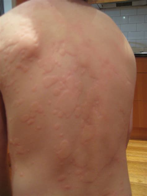 O Que E Urticaria Da Pele - Urticária Na Pele : Urticária: o que é, causas, sintomas e tratamento ...