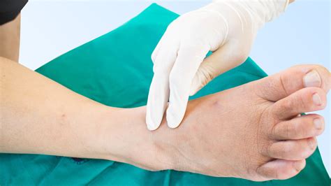 Polyneuropathy | Definition and What Is the Best Treatment?