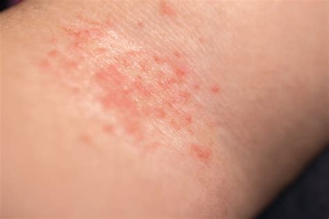 Coceiras Pelo Corpo O Que Pode Ser - Coceira no Corpo Todo? Veja as Principais Causas e Soluções | Vuelo Pharma