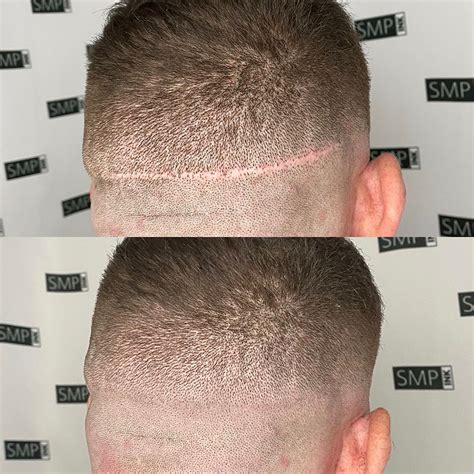 Scar Camouflage Services for Skin | SMP Ink Danville ,CA.