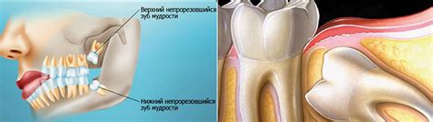 Удаление зубов мудрости