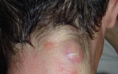 Cancer Tumor On Back Of Neck - CancerWalls