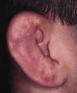 Study Medical Photos: External Ear Injuries - Brief Description With ...