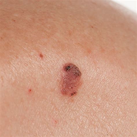 squamous cell carcinoma skin