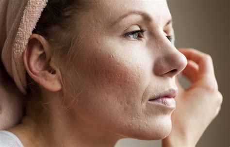 How to Prevent Scarring | What Causes Scars | LloydsPharmacy