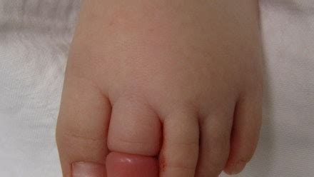 4 Proven Steps To Free A Baby Trapped By A Hair Tourniquet