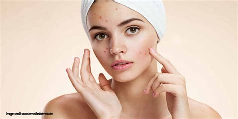 Natural Home Remedies to Remove Deep Acne Marks