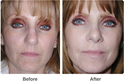Chemical Peel Before and After. Benefits of Acid Peel - HubPages