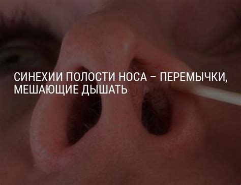 Синехии полости носа: что это такое, причины, симптомы, диагностика ...