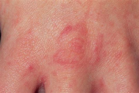 Scabies - NHS