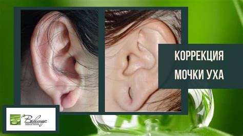 КОРРЕКЦИЯ МОЧКИ УХА - все о процедуре от хирурга. Ревин Артем Андреевич ...