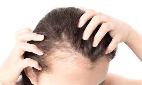 Women's Hair Loss Treatment Reviews at Jessie Hasty blog