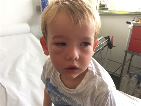 Pollen Allergy Swollen Eyes