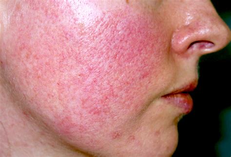 acne rosacea   diagnose  natural cure