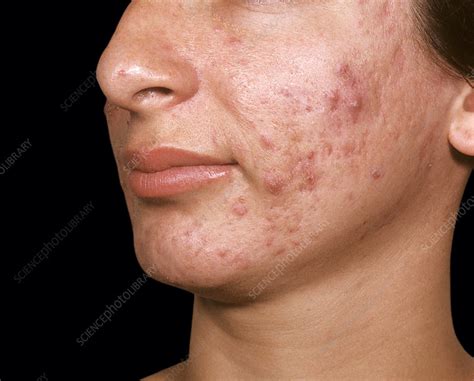 Acne vulgaris - Stock Image - C038/4481 - Science Photo Library