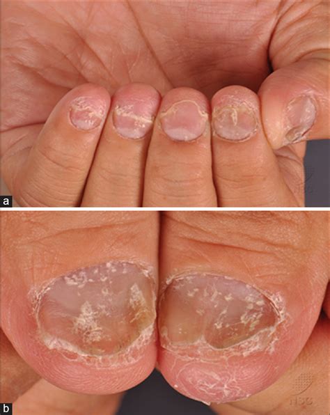 Subungual Hyperkeratosis