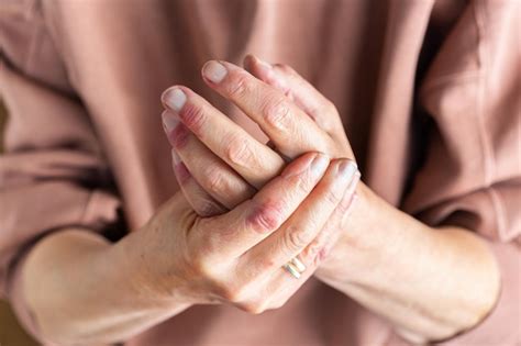 Руки женщины с аллергической реакцией экземы атопического дерматита на ...