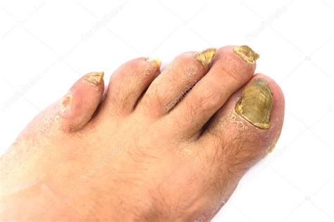 Hongos en las uñas 2024
