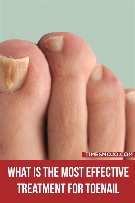 What is the most effective treatment for toenail fungus? - TimesMojo