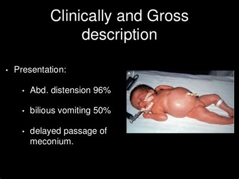 Meconium ileus surgical management