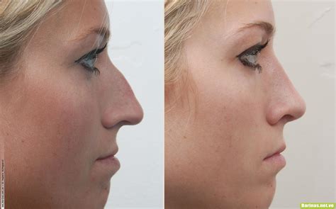 ¿Qué tipos de nariz aplican para una Rinoplastia? - Dr. Jorge Peñarrieta
