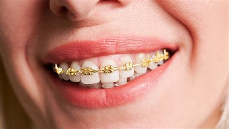 Types of Braces — Lewis Orthodontics