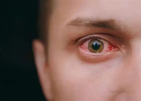 how to get rid of stoned eyes fast