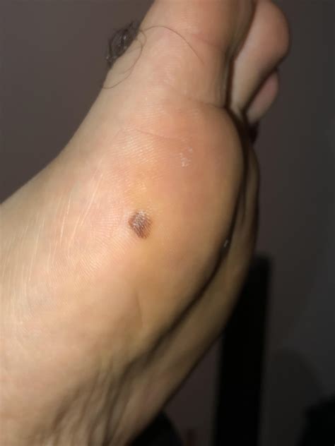 Blood blister or more alarming? : r/skin