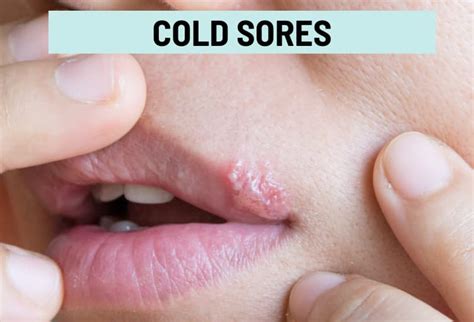 Cold Sore vs. Pimple: Pictures and Differences