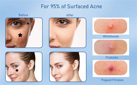 Amazon.com: Black Star Pimple Patches for Face, 153 Counts Hydrocolloid Star Acne Patches, Cute