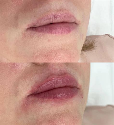 Контурная пластика в Medica Estetic.