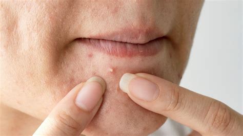 Espinhas No Rosto Do Nada - COMO DIMINUIR ESPINHAS NO ROSTO? | Biofase