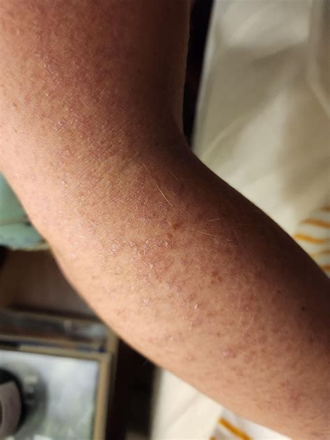 help: scaly rash on arms..starts brown and the skin falls off. doesn't ...