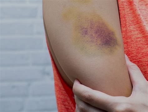 types  bruises