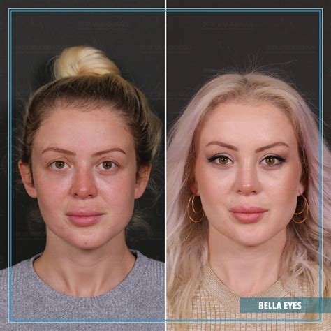 Taylor Swift Plastic Surgeries - Ufuk Askeroğlu