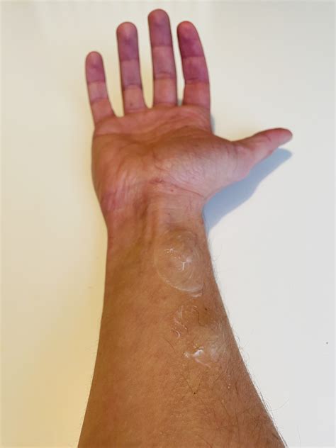 Lipom Creme – Behandlung mit "Lipoma Cream" | Teil 1 – Anleitung