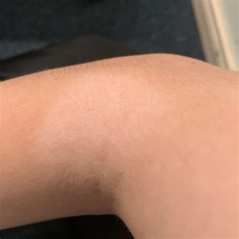 Noticed this rash type area on my right elbow a few months ago it can