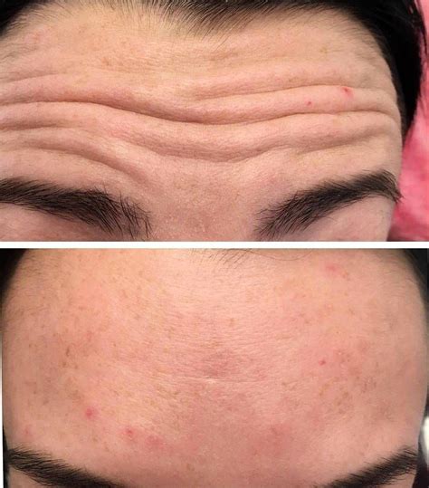 Botox Forehead Lines Before And After | Botox, Botox forehead, Facelift