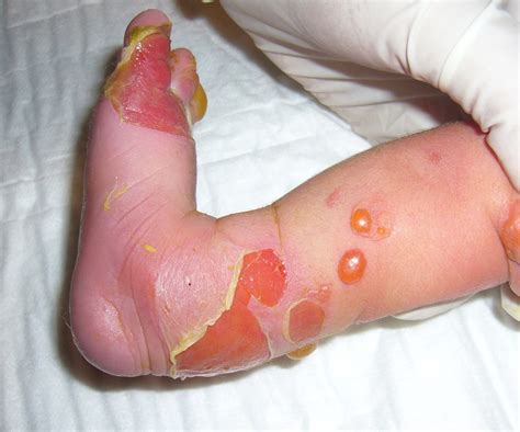 What Is Epidermolysis Bullosa? - Teroes