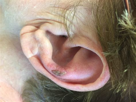 What's this sore on my ear? - Appalachian Spring Dermatology