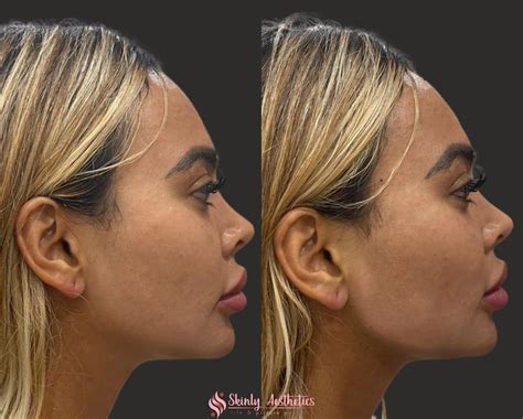 Jawline Fillers - Before & After Results at Skinly