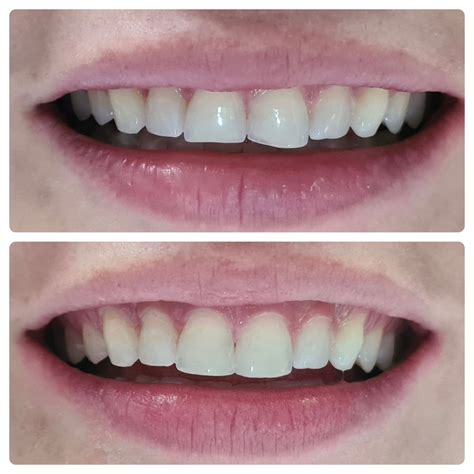 Composite builp up of upper two front teeth - De Vos Dental Clinic Midrand