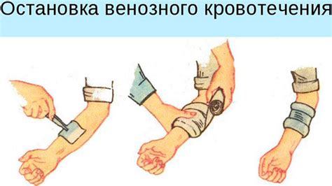 Как осуществляется остановка венозного кровотечения: первая помощь ...