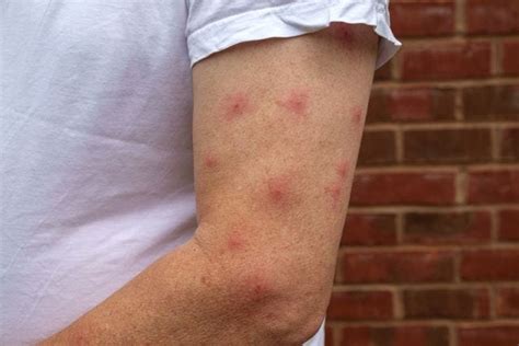 14 Common Bug Bites - Identifying Insect Bites Pictures