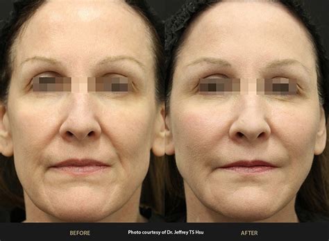 BeautiFill - PHX Plastic Surgery