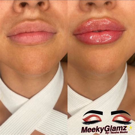 Hyaluronic Acid Lip Fillers – Meeky Glamz