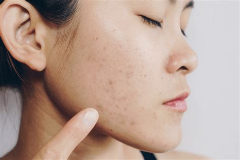 acne treatment  malaysia cleo clinic