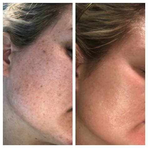 Cosmelan Peel Before and After Results With Photos at PFAM – PRFCT